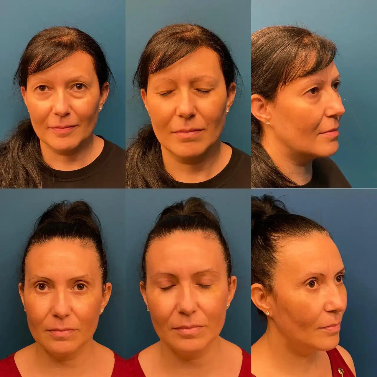 Antes e depois Blefaroplastia em Ribeirão Preto, Dr. Fernando Salgueiro
