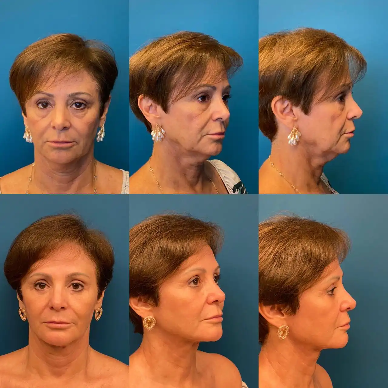 Antes e depois Cirurgia do Olhar em Ribeirão Preto, Dr. Fernando Salgueiro