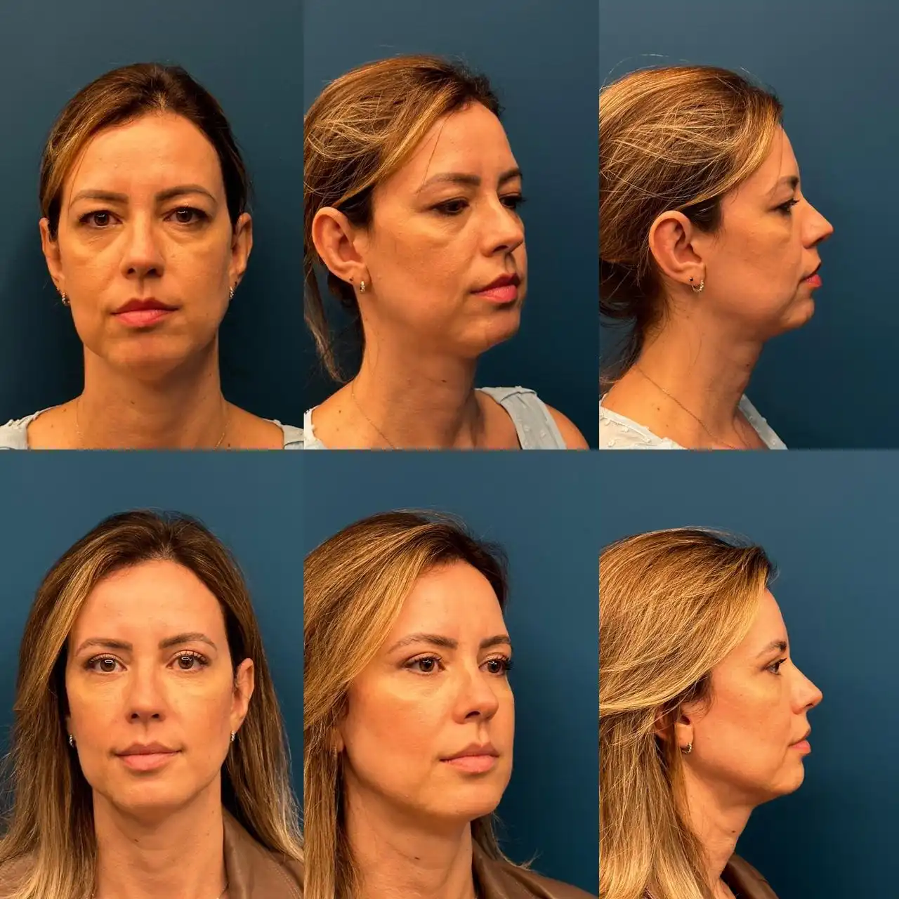 Antes e depois Blefaroplastia Estruturada, Dr. Fernando Salgueiro