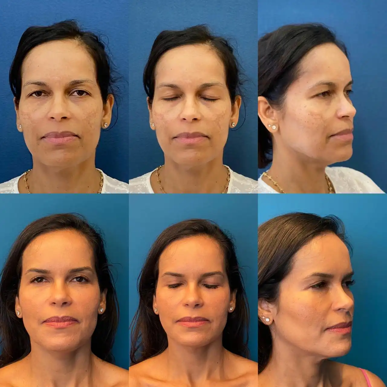 Antes e depois Cirurgia Pálpebras, Dr. Fernando Salgueiro