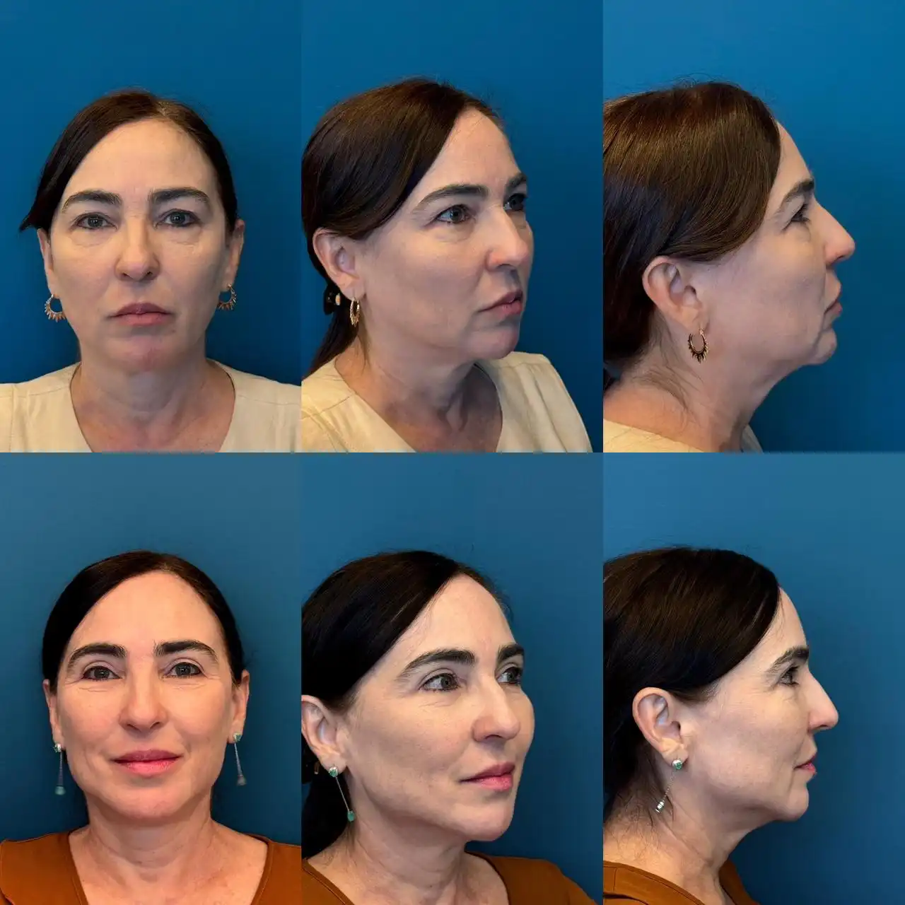 Antes e depois Rejuvenescimento Palpebral, Dr. Fernando Salgueiro