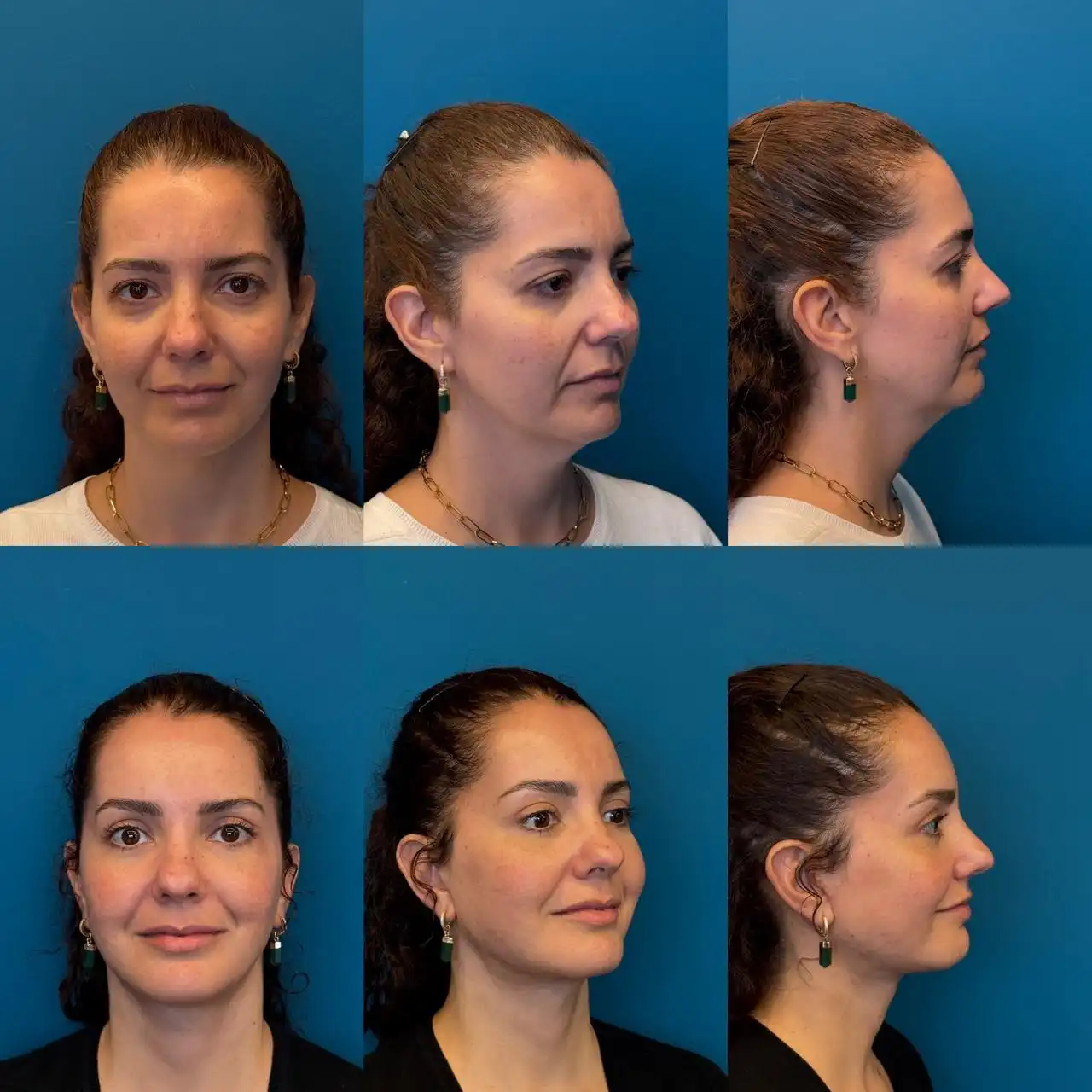 Antes e depois Cirurgia do Olhar Completa, Dr. Fernando Salgueiro