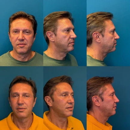 Resultado de Lifting Facial Natural antes e depois - Dr. Fernando Salgueiro.