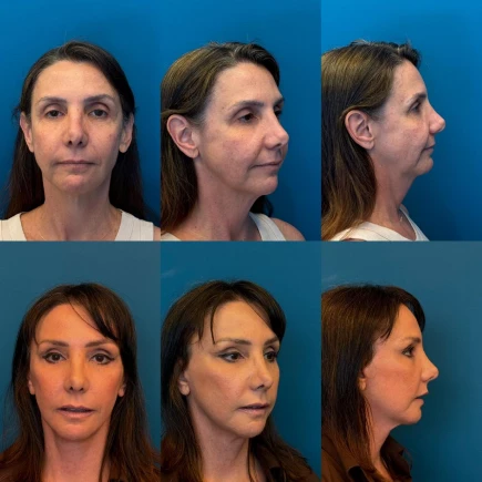 Resultado de Lifting Facial Natural antes e depois - Dr. Fernando Salgueiro.